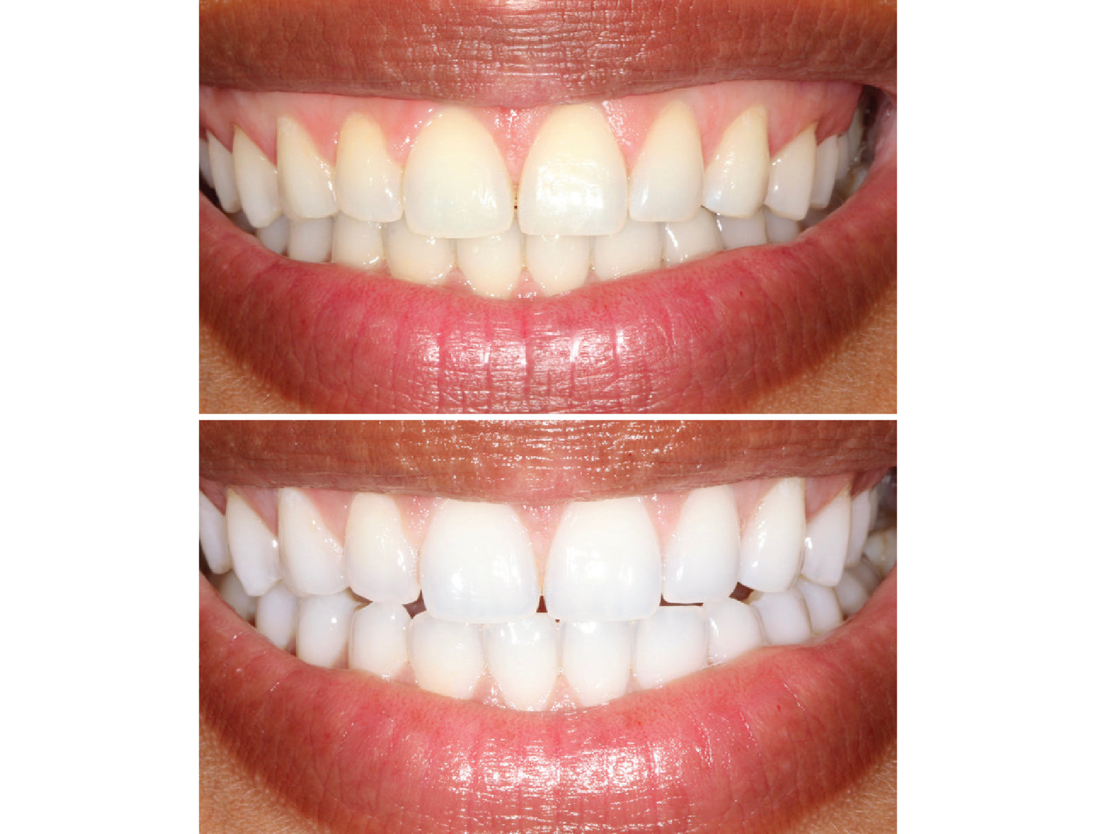 Closeup of two sets of the same smiling teeth showing before and after results from use of Opal Prefilled Whitening Trays